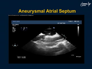 Aneurysmal Atrial Septum
 
