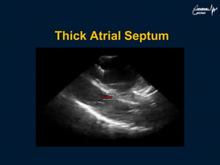 Thick Atrial Septum
 