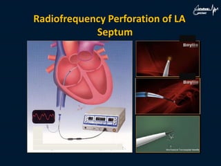 Radiofrequency Perforation of LA
Septum
 