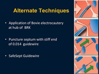 Alternate Techniques
• Application of Bovie electrocautery
at hub of BRK
• Puncture septum with stiff end
of 0.014 guidewire
• SafeSept Guidewire
 