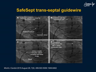 SafeSept trans-septal guidewire
World J Cardiol 2015 August 26; 7(8): 499-503 ISSN 1949-8462
 