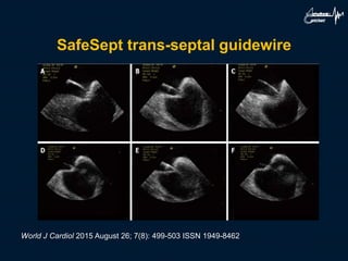 SafeSept trans-septal guidewire
World J Cardiol 2015 August 26; 7(8): 499-503 ISSN 1949-8462
 