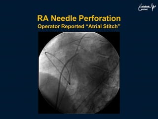 RA Needle Perforation
Operator Reported “Atrial Stitch”
 