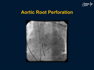Aortic Root Perforation
 
