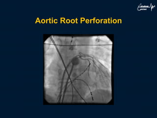 Aortic Root Perforation
 