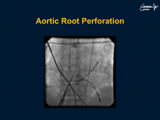 Aortic Root Perforation
 