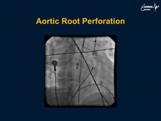 Aortic Root Perforation
 