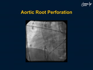 Aortic Root Perforation
 