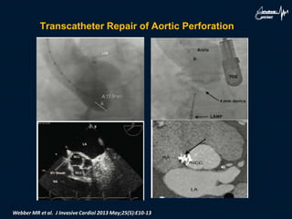 Transcatheter Repair of Aortic Perforation
Webber MR et al. J Invasive Cardiol 2013 May;25(5):E10-13
 