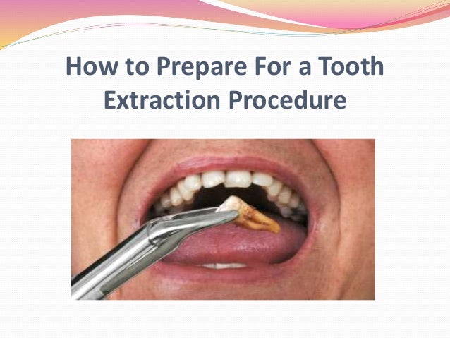 Pulling Teeth: The Steps Of The Extraction Procedure. – ELDJ