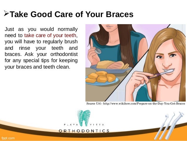 how to prepare for getting braces 20