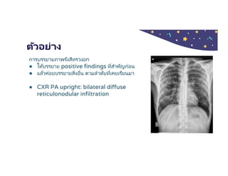 ตัวอย่าง
การบรรยายภาพรังสีทรวงอก
● ให้บรรยาย positive findings ทีสําคัญก่อน
● แล้วค่อยบรรยายสิงอืน ตามลําดับทีเคยเรียนมา
● CXR PA upright: bilateral diffuse
reticulonodular infiltration
 