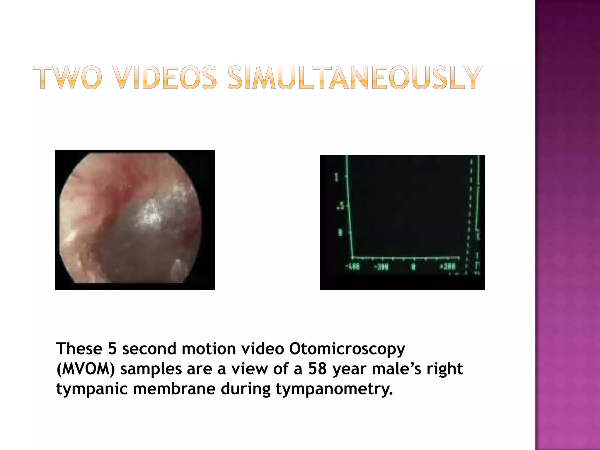 These 5 second motion video Otomicroscopy
(MVOM) samples are a view of a 58 year male’s right
tympanic membrane during tympanometry.
 