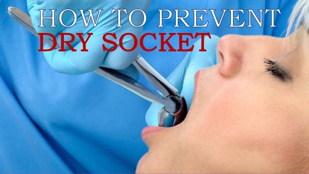 How To Prevent Dry Socket How To Prevent Dry Socket