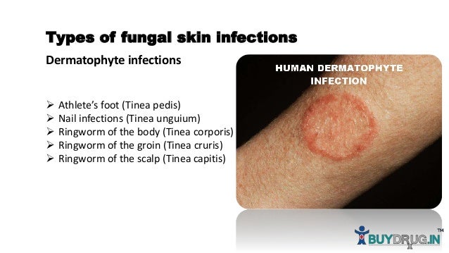 Thrush infection penis