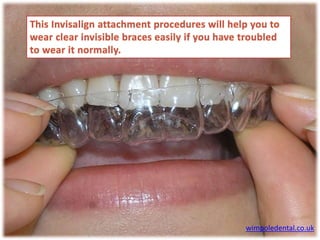 Invisalign Attachments - How to Put It Back in if it Falls Off | PPTX
