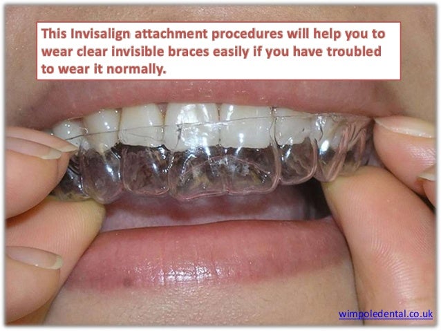 invisalign attachments