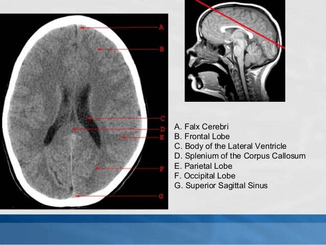 How to read a brain ct scan moderate