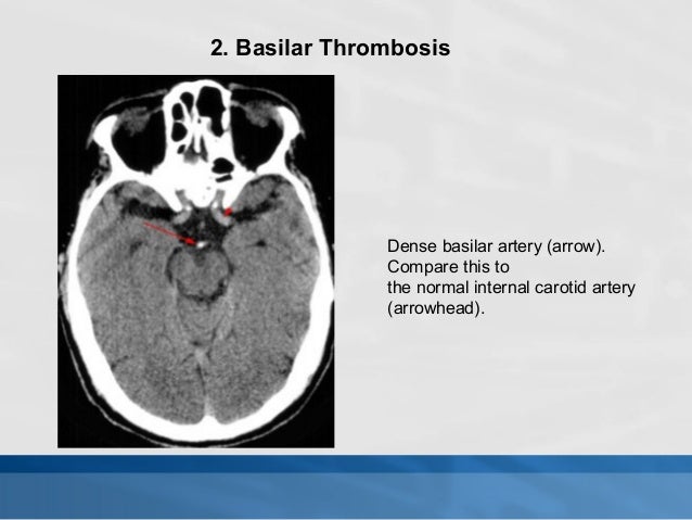 How to read a brain ct scan moderate