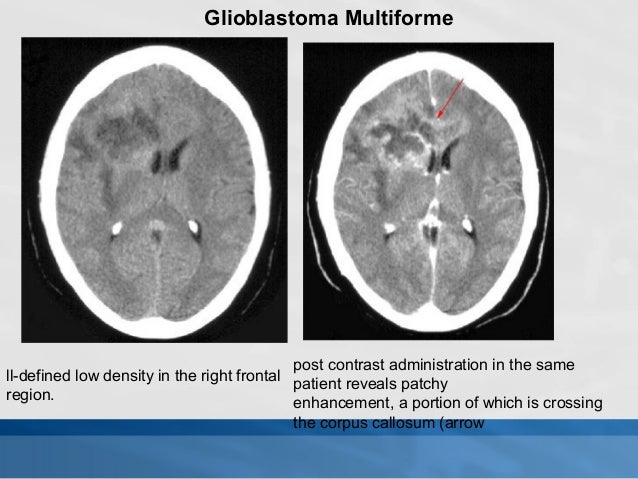 Ct Scan Meaning Tagalog - ct scan machine