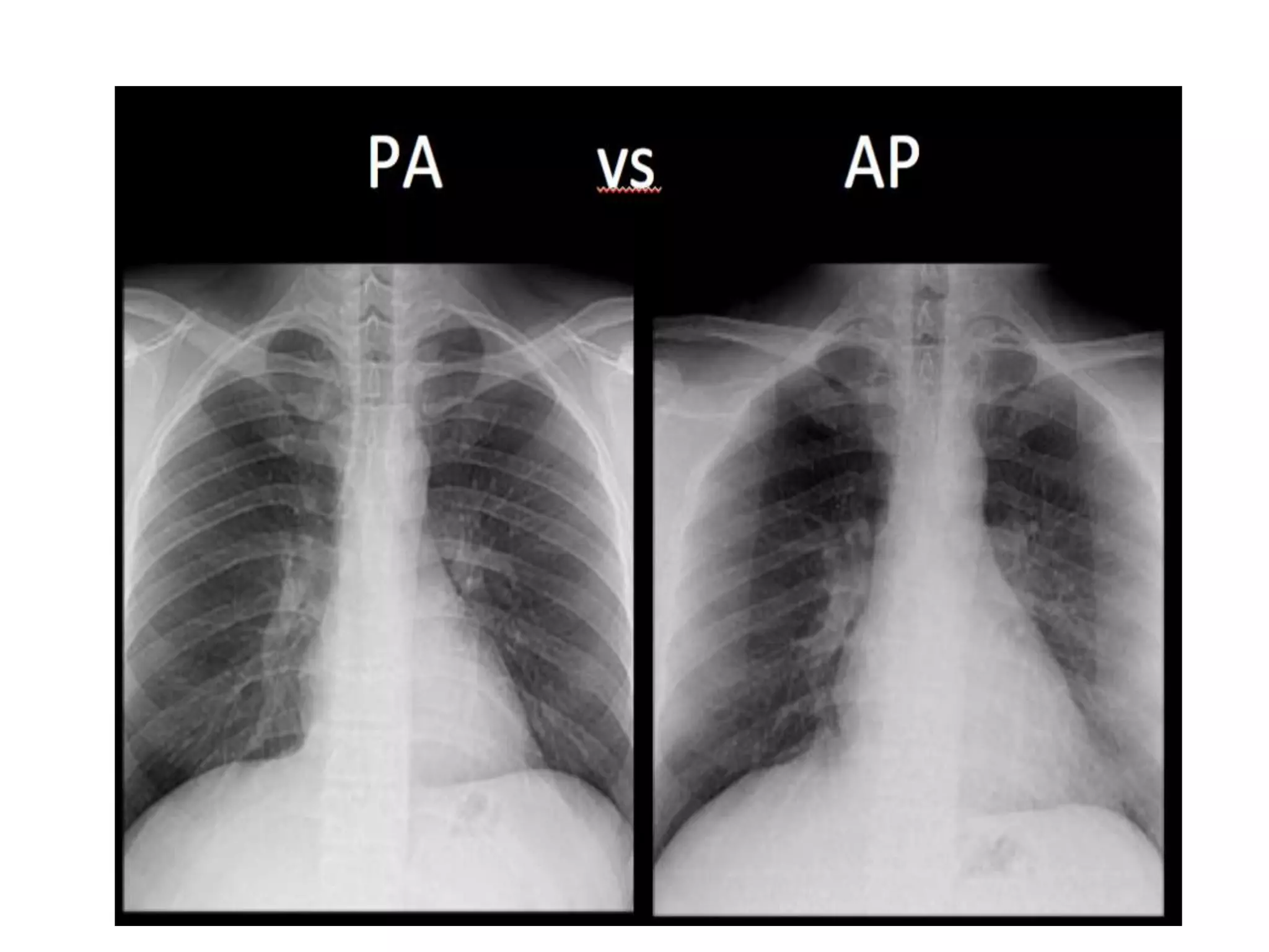 How to read a Chest X Ray film (Radiograph).pptx