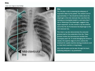 How to read a Chest X Ray film (Radiograph).pptx