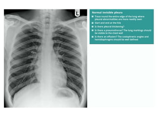 How to read a Chest X Ray film (Radiograph).pptx