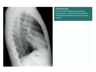 How to read a Chest X Ray film (Radiograph).pptx