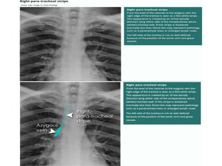 How to read a Chest X Ray film (Radiograph).pptx