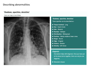 How to read a Chest X Ray film (Radiograph).pptx