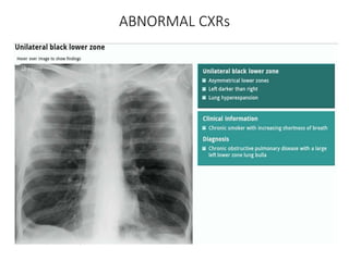 How to read a Chest X Ray film (Radiograph).pptx