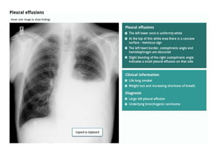 How to read a Chest X Ray film (Radiograph).pptx