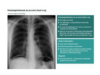 How to read a Chest X Ray film (Radiograph).pptx