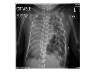 How to read a Chest X Ray film (Radiograph).pptx