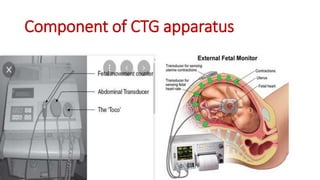 Component of CTG apparatus
 
