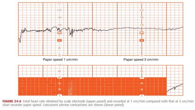 How to read a CTG دكتور صلاح رزق.pptx