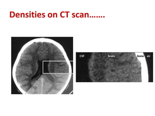 Densities on CT scan…….
 