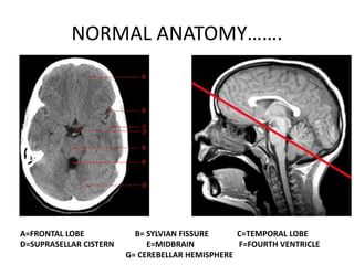 NORMAL ANATOMY…….
A=FRONTAL LOBE B= SYLVIAN FISSURE C=TEMPORAL LOBE
D=SUPRASELLAR CISTERN E=MIDBRAIN F=FOURTH VENTRICLE
G= CEREBELLAR HEMISPHERE
 