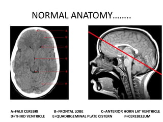 NORMAL ANATOMY……..
A=FALX CEREBRI B=FRONTAL LOBE C=ANTERIOR HORN LAT VENTRICLE
D=THIRD VENTRICLE E=QUADRIGEMINAL PLATE CISTERN F=CEREBELLUM
 