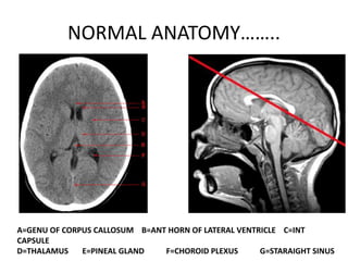 NORMAL ANATOMY……..
A=GENU OF CORPUS CALLOSUM B=ANT HORN OF LATERAL VENTRICLE C=INT
CAPSULE
D=THALAMUS E=PINEAL GLAND F=CHOROID PLEXUS G=STARAIGHT SINUS
 