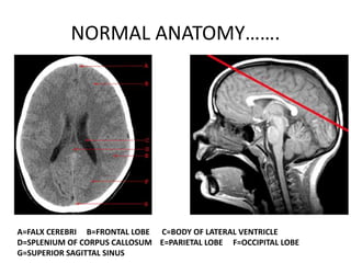 NORMAL ANATOMY…….
A=FALX CEREBRI B=FRONTAL LOBE C=BODY OF LATERAL VENTRICLE
D=SPLENIUM OF CORPUS CALLOSUM E=PARIETAL LOBE F=OCCIPITAL LOBE
G=SUPERIOR SAGITTAL SINUS
 