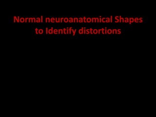 Normal neuroanatomical Shapes
to Identify distortions
 