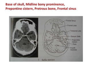 Base of skull, Midline bony prominence,
Prepontine cistern, Pretrous bone, Frontal sinus
 