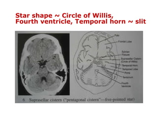Star shape ~ Circle of Willis,
Fourth ventricle, Temporal horn ~ slit
 