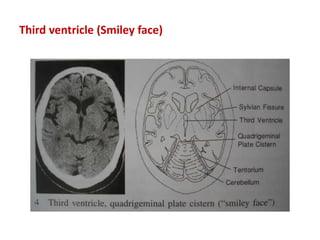 Third ventricle (Smiley face)
 