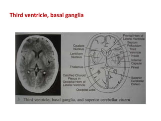 Third ventricle, basal ganglia
 
