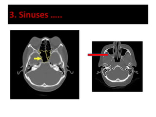 3. Sinuses …..
 