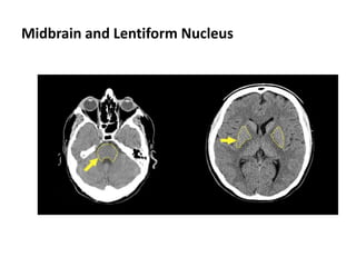 Midbrain and Lentiform Nucleus
 