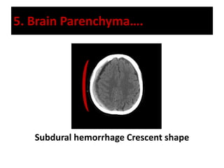 5. Brain Parenchyma….
Subdural hemorrhage Crescent shape
 