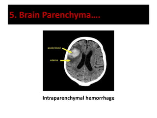 5. Brain Parenchyma….
Intraparenchymal hemorrhage
 